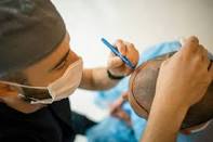 FUE hair transplant la surgery